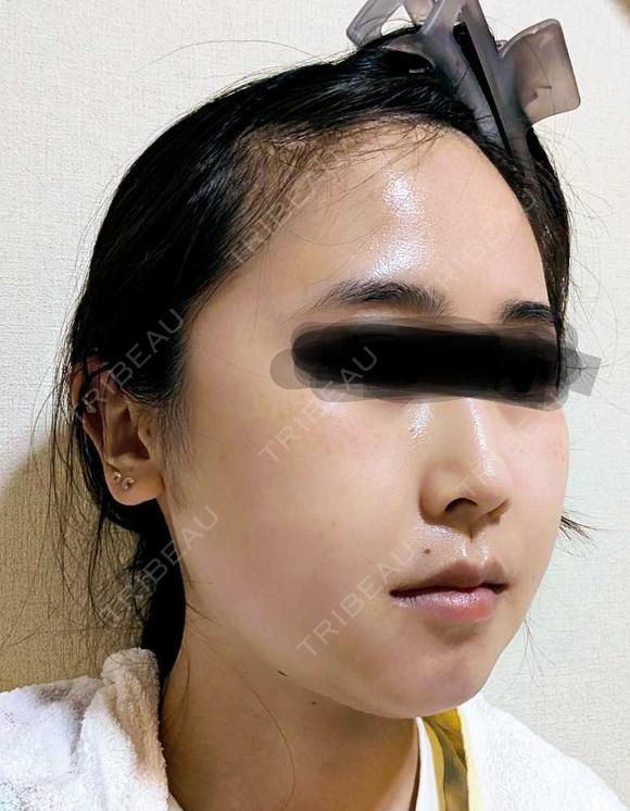 骨切り（あご） / 骨削り（エラ） / 骨削り（頬） セギム美容整形外科 DAY 14 メイン用