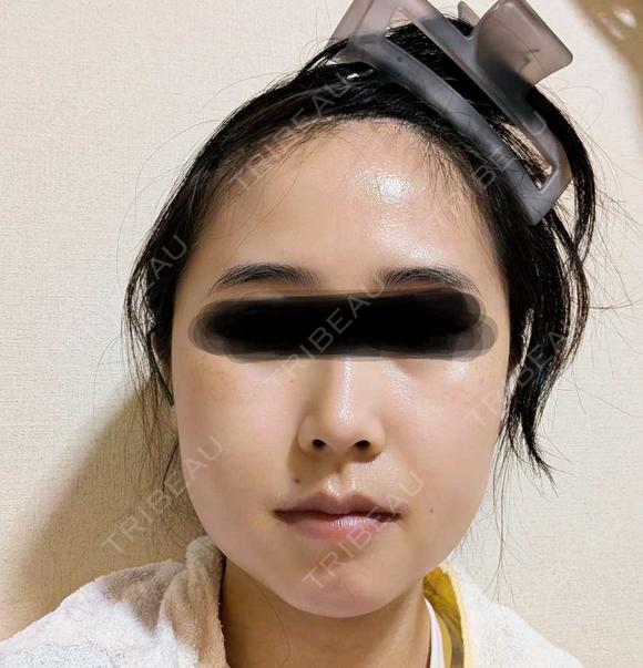 骨切り（あご） / 骨削り（エラ） / 骨削り（頬） セギム美容整形外科 DAY 14 メイン用