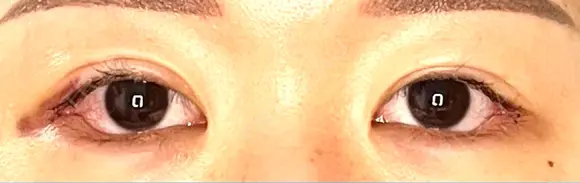 目尻切開 / タレ目形成・グラマラスライン（埋没） LOUIS CLINIC 二子玉川院【ルイクリニック】 DAY 4 メイン用