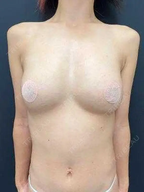 豊胸（脂肪注入） 湘南美容クリニック 吉祥寺院 DAY 31 メイン用