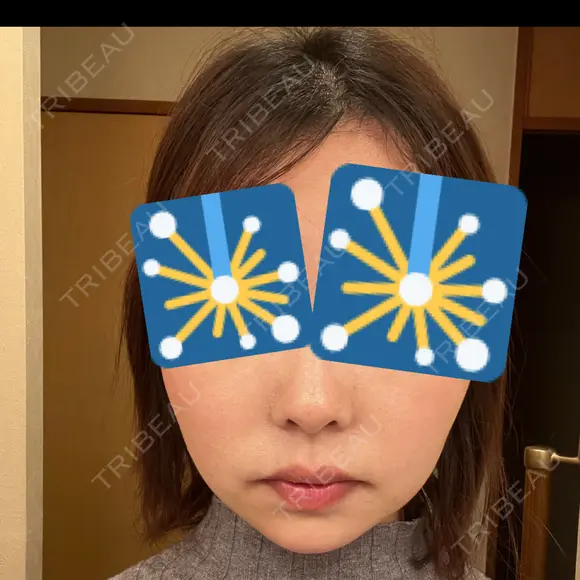 ジョールファット除去 / 脂肪吸引注射（顔） 湘南美容クリニック 大阪梅田本院 DAY 5 メイン用