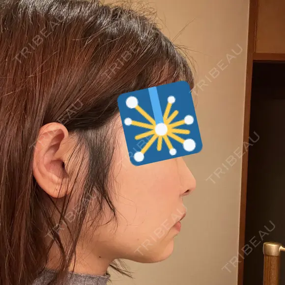 ジョールファット除去 / 脂肪吸引注射（顔） 湘南美容クリニック 大阪梅田本院 DAY 5 メイン用