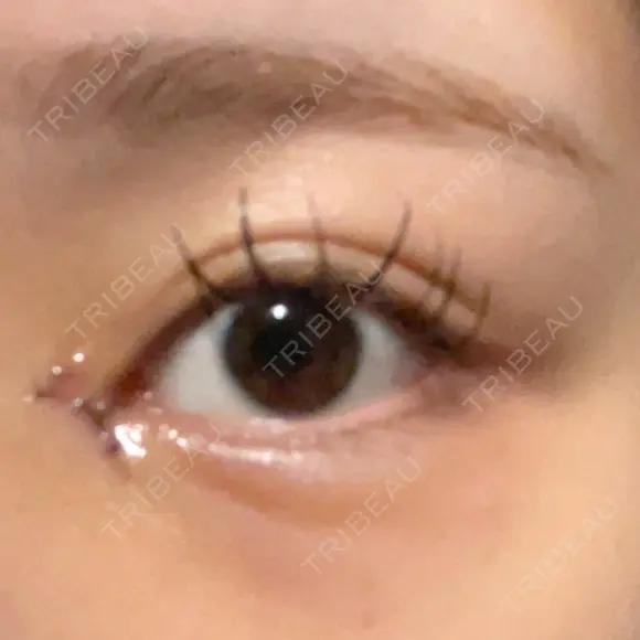 目頭切開 9BeautyClinic DAY 3 メイン用