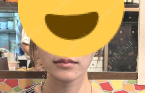 ヒアルロン酸注入（涙袋） / ヒアルロン酸注入（唇） / ボトックス（口角） おおたかの森ビューティークリニック DAY 5 メイン用