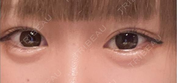ヒアルロン酸注入（涙袋） / ヒアルロン酸注入（唇） / ボトックス（口角） おおたかの森ビューティークリニック AFTER メイン用