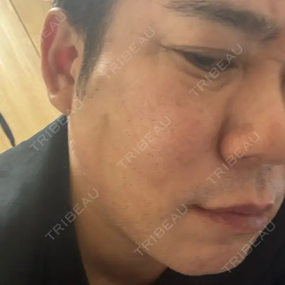 脂肪吸引注射（顔） / ボトックス（エラ・小顔） / その他（肌） LOUIS CLINIC 二子玉川院【ルイクリニック】 DAY 3 メイン用