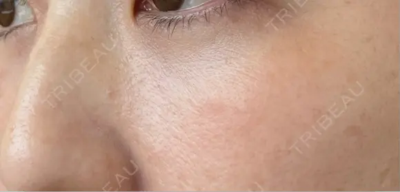 クマ治療 / 下まぶたの脂肪取り ROOTS Clinic DAY 26 メイン用