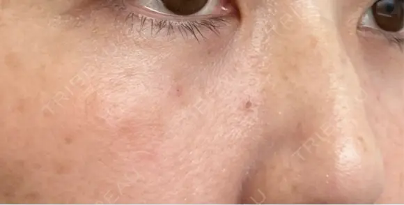 クマ治療 / 下まぶたの脂肪取り ROOTS Clinic DAY 26 メイン用