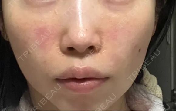 ヒアルロン酸注入（頬） 湘南美容クリニック 大阪梅田本院 DAY 1 メイン用