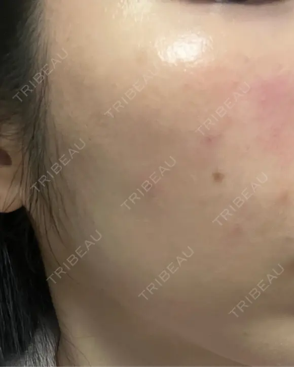 ヒアルロン酸注入（頬） 湘南美容クリニック 大阪梅田本院 DAY 1 メイン用