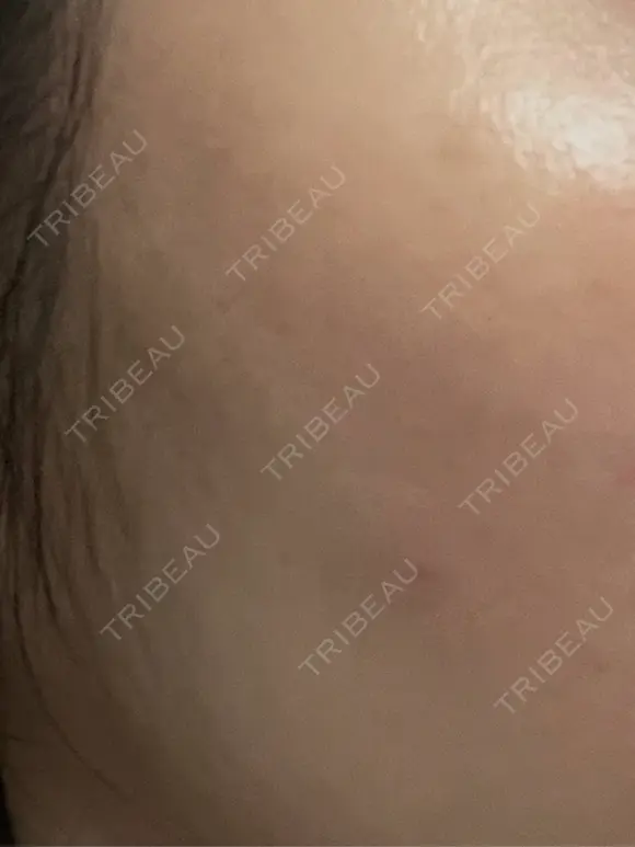 ヒアルロン酸注入（頬） 湘南美容クリニック 大阪梅田本院 DAY 1 メイン用