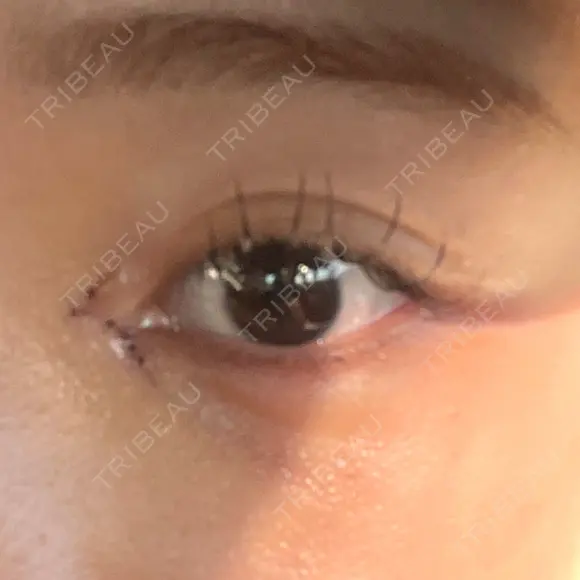 目頭切開 9BeautyClinic DAY 4 メイン用