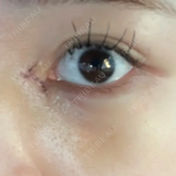 目頭切開 9BeautyClinic DAY 5 メイン用