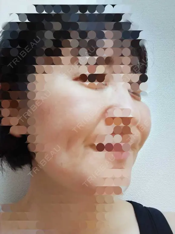 肌ヒアルロン酸注入（たるみ・シワ改善） / シワ取りボトックス 東京形成美容外科 船橋院 DAY 15 メイン用