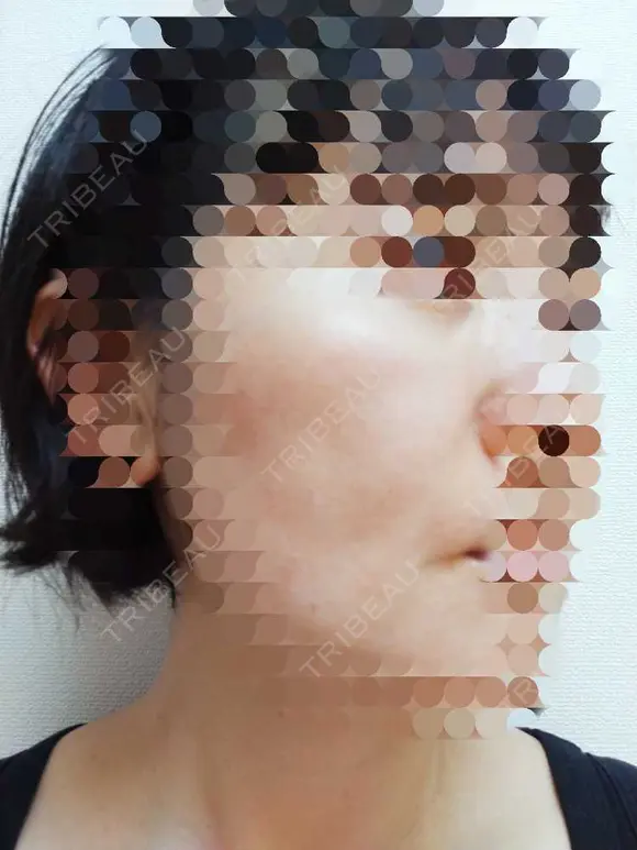肌ヒアルロン酸注入（たるみ・シワ改善） / シワ取りボトックス 東京形成美容外科 船橋院 DAY 15 メイン用