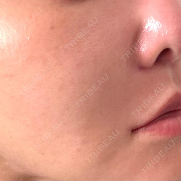 脂肪溶解注射（顔） WellnessPlus Clinic 【ウェルネスプラスクリニック】 DAY 16 メイン用