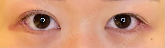 目尻切開 / タレ目形成・グラマラスライン（埋没） LOUIS CLINIC 二子玉川院【ルイクリニック】 DAY 7 メイン用