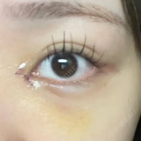 目頭切開 9BeautyClinic DAY 6 メイン用
