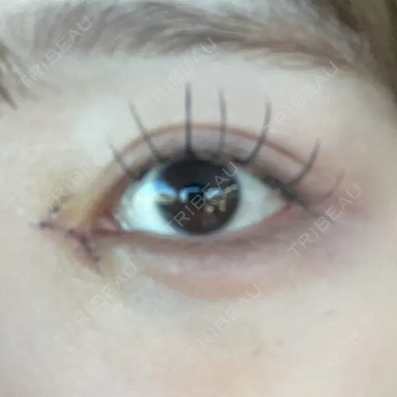 目頭切開 9BeautyClinic DAY 7 メイン用