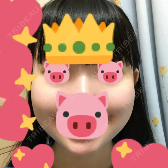 ボトックス（エラ・小顔） / 脂肪溶解注射（顔） 湘南美容クリニック 松戸院 DAY 153 メイン用