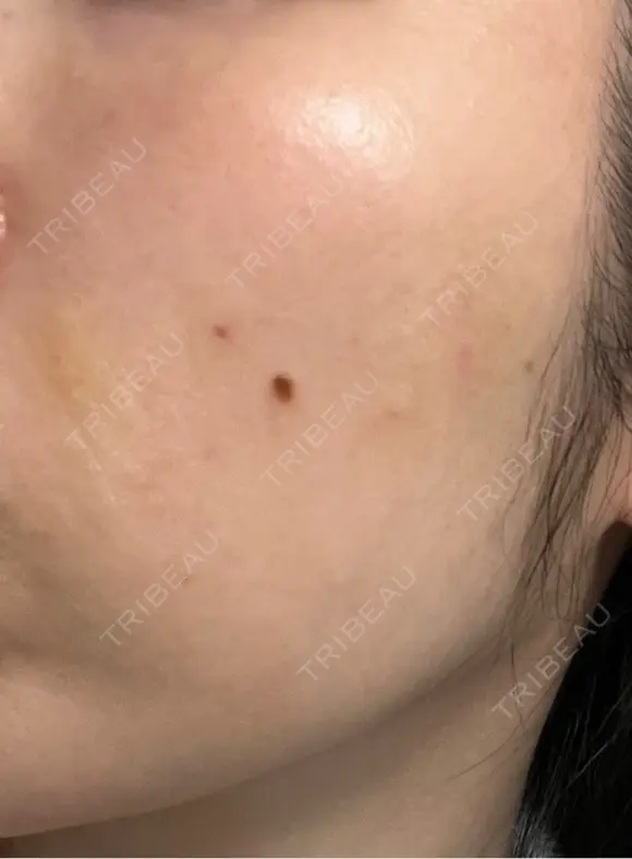 ヒアルロン酸注入（頬） 湘南美容クリニック 大阪梅田本院 DAY 4 メイン用