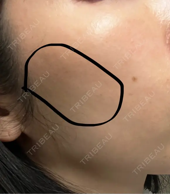 ヒアルロン酸注入（頬） 湘南美容クリニック 大阪梅田本院 DAY 4 メイン用