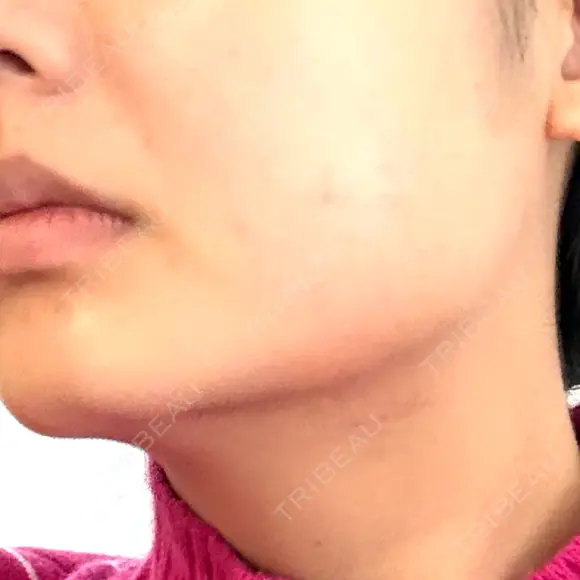 その他（肌） CIEL SKIN CLINIC（シエルスキンクリニック） AFTER メイン用
