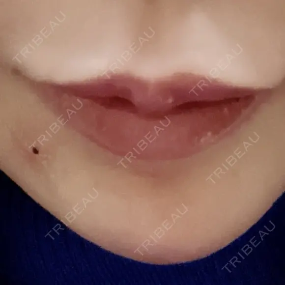 アートメイク（ほくろ） 新宿クレアクリニック AFTER メイン用