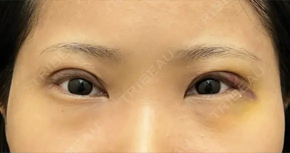 眼瞼下垂（切開） 渋谷の森クリニック DAY 7 メイン用