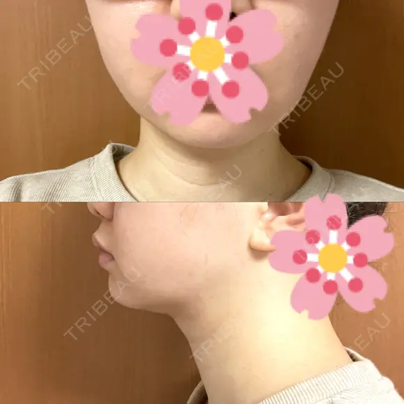 糸リフト / 脂肪吸引（顔） EMMA CLINIC（エマクリニック） AFTER メイン用
