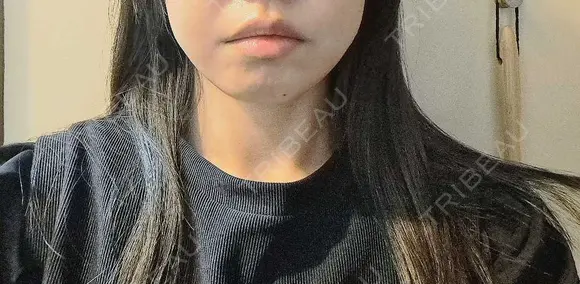 ボトックス（口角） おおたかの森ビューティークリニック AFTER メイン用