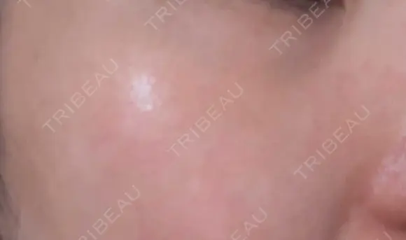 シミ取りレーザー / その他（目元） 共立美容外科 仙台院 DAY 42 メイン用