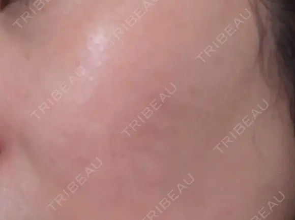 シミ取りレーザー / その他（目元） 共立美容外科 仙台院 AFTER メイン用