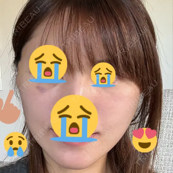 切開リフト 東京エビスクリニック DAY 15 メイン用