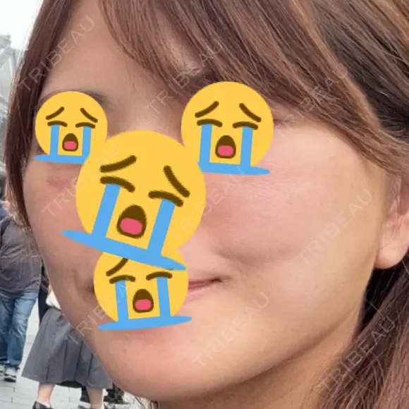 切開リフト 東京エビスクリニック DAY 16 メイン用