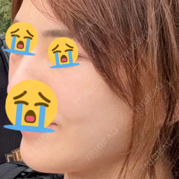 切開リフト 東京エビスクリニック DAY 16 メイン用