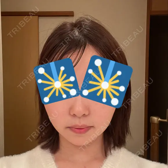 ジョールファット除去 / 脂肪吸引注射（顔） 湘南美容クリニック 大阪梅田本院 DAY 13 メイン用