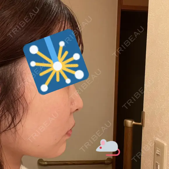 ジョールファット除去 / 脂肪吸引注射（顔） 湘南美容クリニック 大阪梅田本院 DAY 13 メイン用