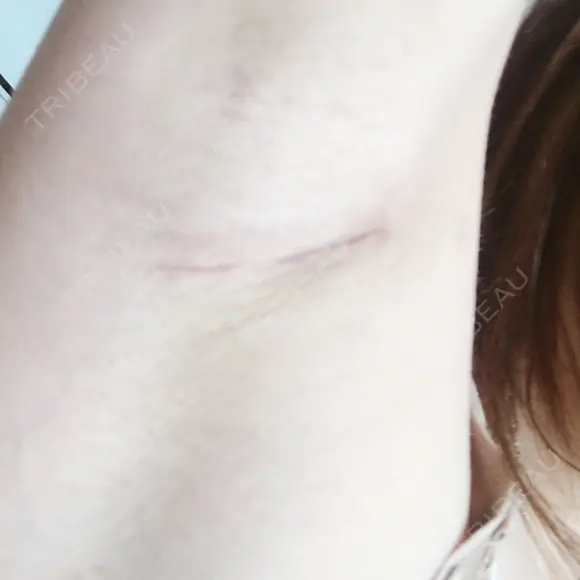 豊胸（シリコンバッグ） / 胸修正 NANA（ナナ）美容外科 DAY 25 メイン用