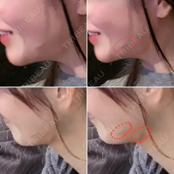 糸リフト / バッカルファット除去 / 脂肪吸引（顔） / ジョールファット除去 BLINC CLINIC （ブリンク クリニック） DAY 97 メイン用