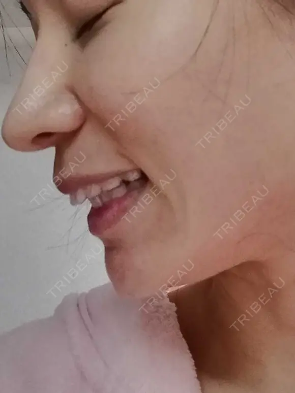 矯正（マウスピース） 銀座青山You矯正歯科 池袋西口医院 DAY 223 メイン用