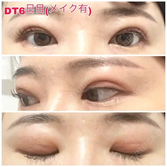 二重埋没 城本クリニック 福岡院 DAY 6 メイン用