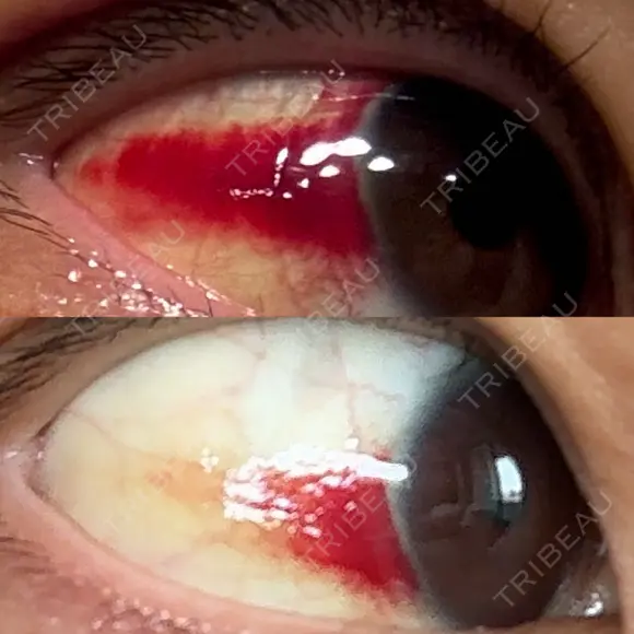 切開リフト 東京エビスクリニック DAY 19 メイン用