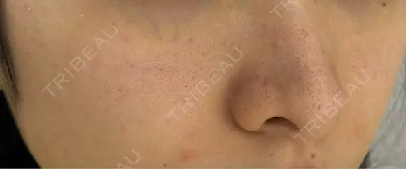 マイクロボトックス lime clinic （杏クリニック） DAY 0 メイン用