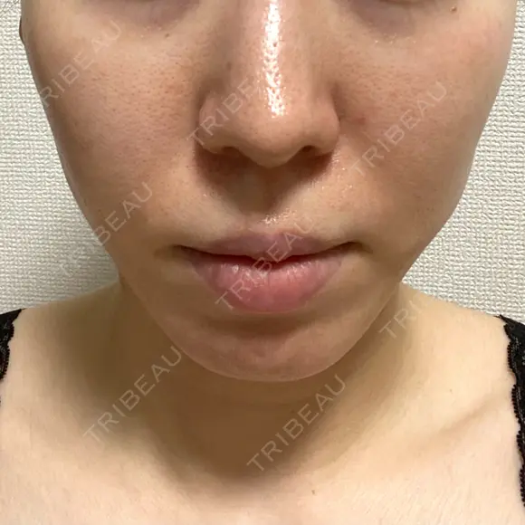 糸リフト / 脂肪吸引（顔） EMMA CLINIC（エマクリニック） AFTER メイン用