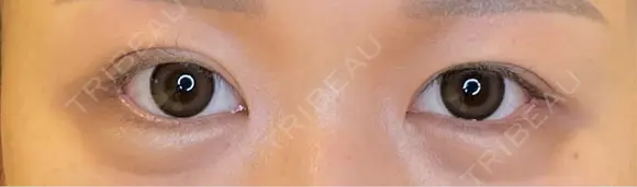 目尻切開 / タレ目形成・グラマラスライン（埋没） LOUIS CLINIC 二子玉川院【ルイクリニック】 AFTER メイン用