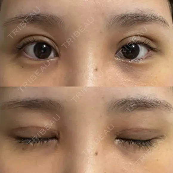 二重切開 / 目頭切開 オーキッド美容クリニック東京御徒町 DAY 10 メイン用