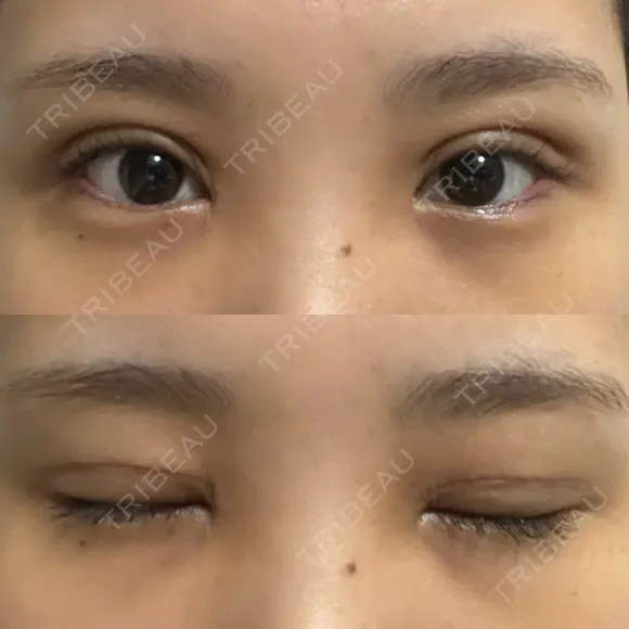 二重切開 / 目頭切開 オーキッド美容クリニック東京御徒町 DAY 11 メイン用