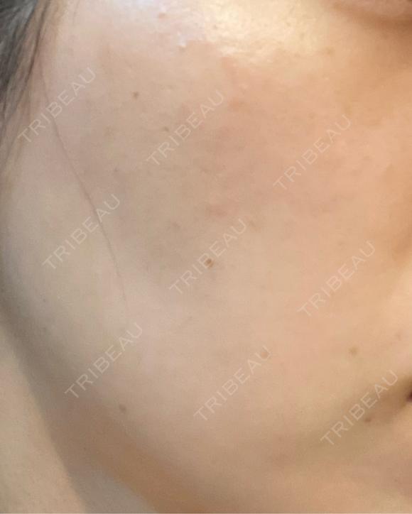 ほくろ・いぼ切除（肌） / イオン導入 / ピーリング（ハリ・ツヤ） / ルメッカ ルラ美容クリニック 静岡院 AFTER メイン用