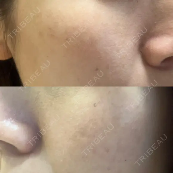 光治療（フォトフェイシャルなど） 小木曽クリニック DAY 4 メイン用